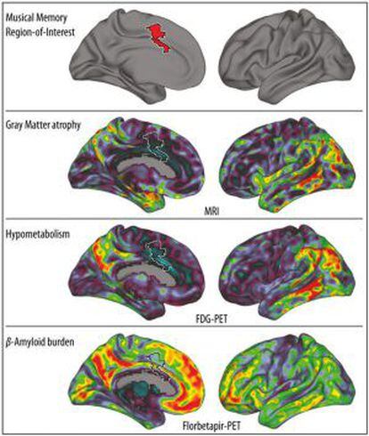 El gráfico muestra (en rojo, arriba) el giro cingulado anterior donde se almacenan los recuerdos musicales. Más abajo, visión bilateral de tres biomarcadores de Alzhéimer, en rojo las más afectadas.