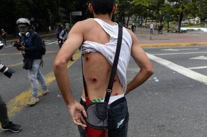 Un manifestante muestra las heridas de perdigones en su espalda, tras los enfrentamientos con la Guardia Nacional Bolivariana, en el este de Caracas. El Observatorio Venezolano de Conflictividad Social (OVCS) ha cifrado en 26 el número de muertos.