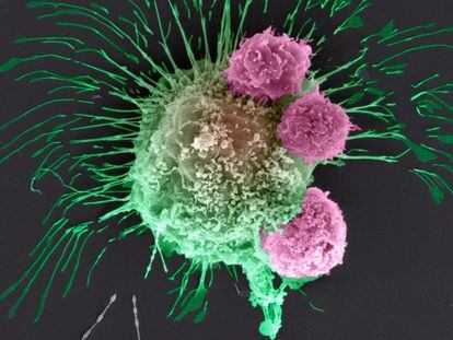 Vista al microscopio de una célula de cáncer de mama atacada por tres linfocitos del sistema inmune.