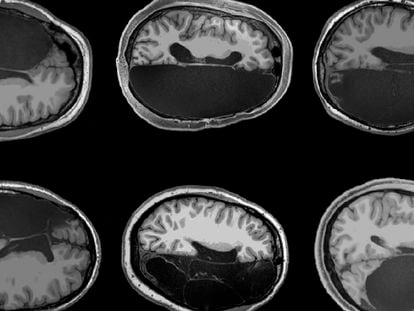 Imágenes de cerebros con la mitad extirpada. Firma: Caltech Brain Imaging Center


