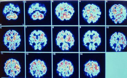 Serie de im&aacute;genes del cerebro de un paciente de Alzh&eacute;imer.