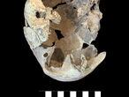 Cráneo de la anciana con perforaciones hallado en el dolmen del Perdón.