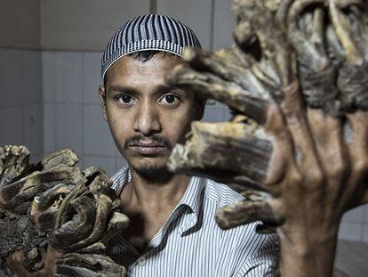 Abul Bajandar muestra sus manos antes de la operación.