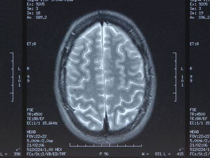 Imagen médica de la sección de un cerebro.