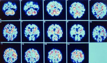 Deteriorament de diferents parts del cervell causat per l'alzheimer.