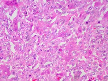 Neoplasia de células gigantes del tejido subcutáneo.
