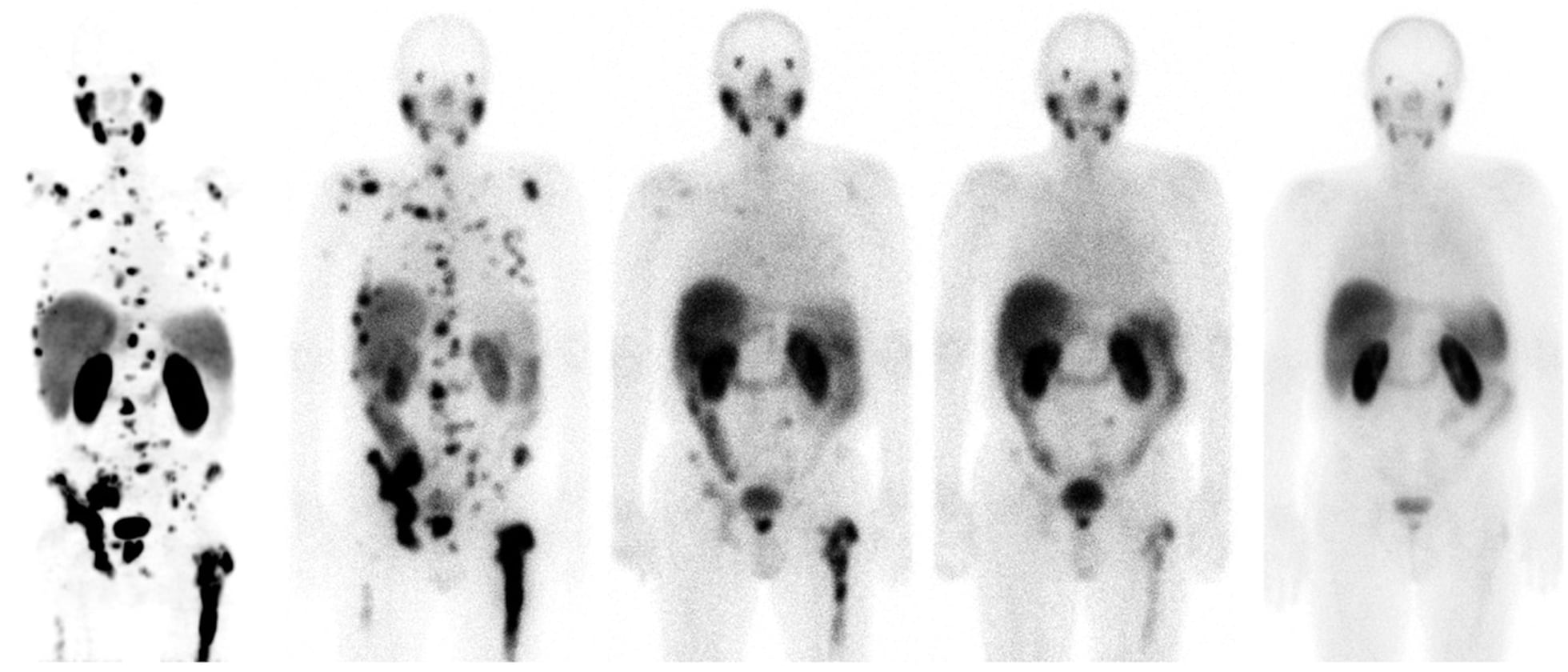 se puede curar el cáncer de próstata con metástasis)