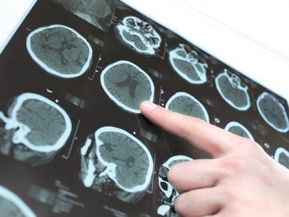 Un neurólogo señala las imágenes de un cerebro humano obtenidas por escáner.
