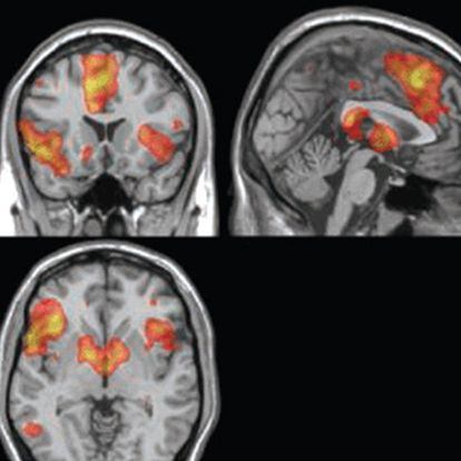 Registro de la activación cerebral en experimentos con resonancia magnética funcional.