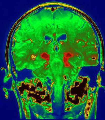 Imagen de un cerebro de una persona con párkinson.