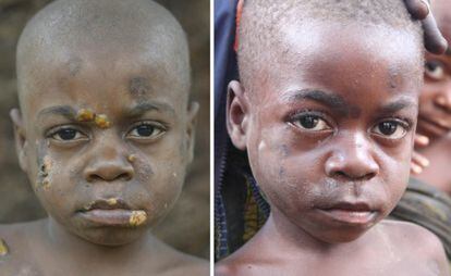 Un nen pigmeu, abans i després del tractament contra el pian.