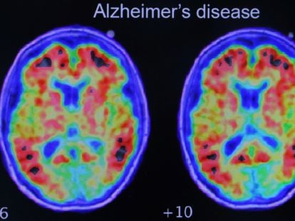 Evidencia de alzhéimer en un estudio realizado con tomografía por emisión de positrones.
