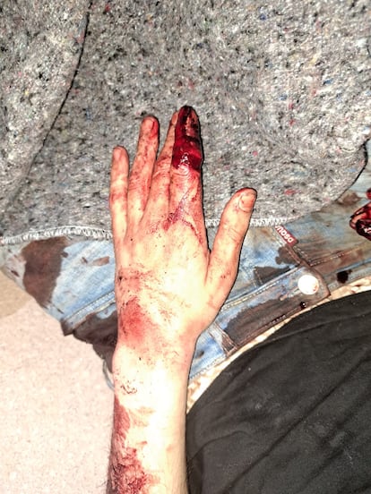 Así quedó la mano derecha del hombre que logró huir en Marbella tras ser torturado. Foto facilitada por la Policía Nacional.