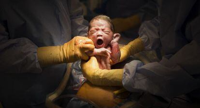 Un niño naciendo mediante cesárea