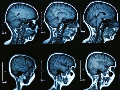 Resonancia magnética de un cerebro humano.
