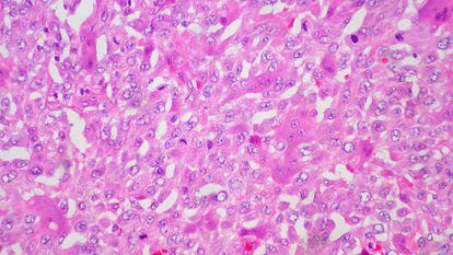 Neoplasia de células gigantes del tejido subcutáneo.
