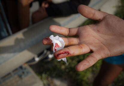 Mohamed, de 17 años, muestra la herida que cuenta que se hizo con las alambradas al escapar del campamento de Piniers en Ceuta.