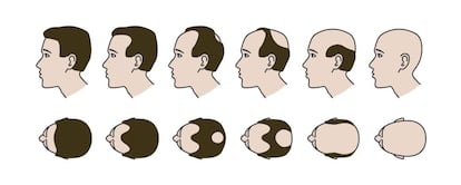 Evolución de la calvicie: a menudo, la autoestima y el sueño se van con el pelo.