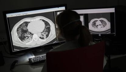 Una doctora examina una radiografía pulmonar de un paciente de coronavirus en el hospital Montlegia de Lieja, Bélgica, el 27 de marzo. 