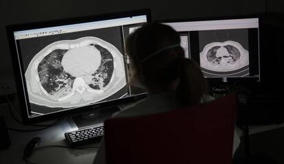 Una doctora examina una radiografía pulmonar de un paciente de coronavirus en el hospital Montlegia de Lieja, Bélgica, el 27 de marzo.