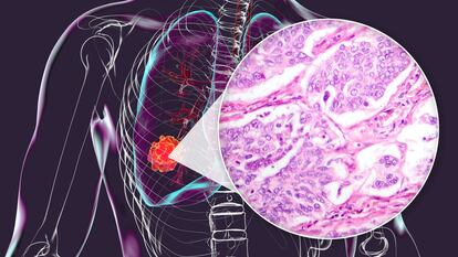 Las herramientas que hacen el diagnóstico de cáncer de pulmón cada vez más preciso  