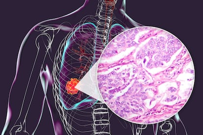 Imagen de un tumor.