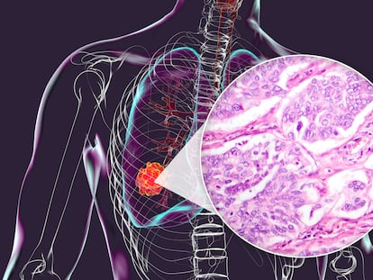Lung cancer, 3D illustration and light micrograph - Cáncer de pulmón - Astrazeneca - Transformar hoy el mañana - biopsia líquida