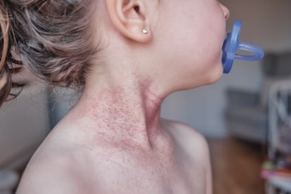 Baby girl with atopic dermatitis,type of eczema,is an inflammatory