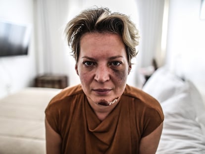 A deputada Joice Hasselmann (PSL-SP) é fotografada com hematomas no rosto em seu apartamento funcional em Brasília, na última sexta-feira.