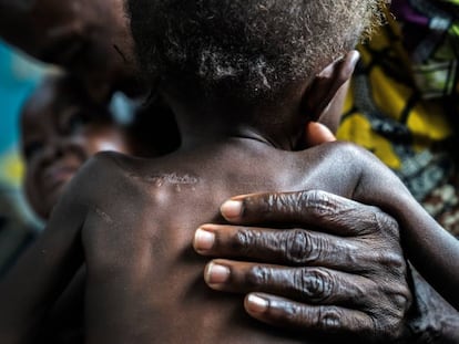 Unos gemelos desnutridos de 17 meses son llevados al centro de salud de Ditekemena, en República Democrática del Congo, por sus abuelos. Estuvieron cinco meses ocultos entre el matorral, después de que las milicias atacasen su aldea. Los padres fueron asesinados y los bebés sufrieron varias cuchilladas.