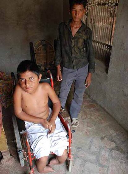 Jagdev Singh no puede andar ni mover los brazos. Según los médicos, por una excesiva exposición a la urea.