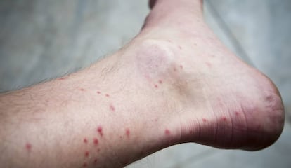 Picaduras de mosquito en el tobillo de un hombre.
