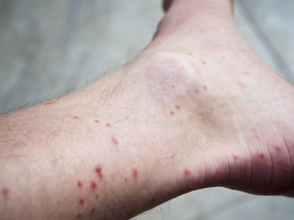 Picaduras de mosquito en el tobillo de un hombre.