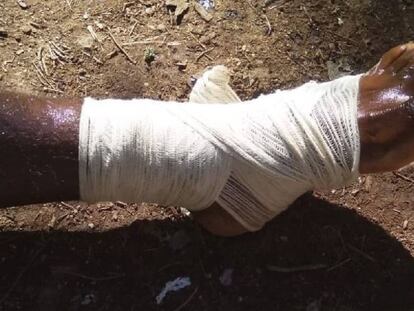 Una de las personas heridas al quedarse atrapadas en la frontera entre Melilla y Marruecos.