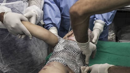 Varios médicos aplican piel de tilapia en un bebé de un año y medio, quemado con agua caliente, en hospital de Fortaleza (Brasil).