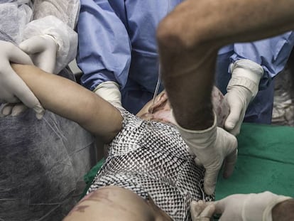 Varios médicos aplican piel de tilapia en un bebé de un año y medio, quemado con agua caliente, en hospital de Fortaleza (Brasil).