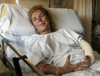 Júlia Vilaró Rodríguez, una de las españolas heridas en el atentado ocurrido en Marib (Yemen), ingresada en la Unidad de Traumatología y Rehabilitación del Hospital Universitario Valle de Hebrón de Barcelona, el 11 de julio de 2007.