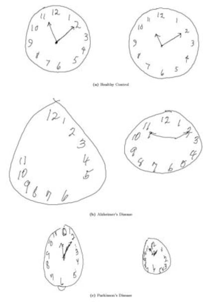 En la imagen se muestran las diferencias en los dibujos según la enfermedad. La primera fila muestra dos relojes realizados por pacientes sanos. En la fila central, el paciente sufre de la enfermedad de Alzheimer y en la fila inferior, Parkinson.