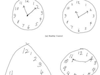 Na imagem são mostradas as diferenças nos desenhos de acordo com a doença. A primeira fila mostra dois relógios feitos por pacientes sãos. Na fila central, o paciente sofre de Alzheimer e na fila inferior, Parkinson.