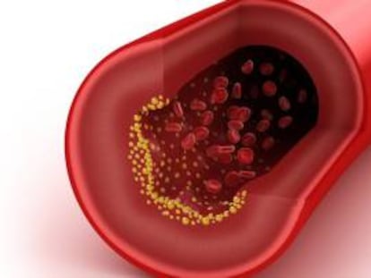 Representación de un vaso sanguíneo con colesterol.