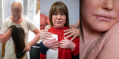 Ariadna suffers from alopecia due to harlequin-type ichthyosis and has been wearing a wig since she was 11 years old.