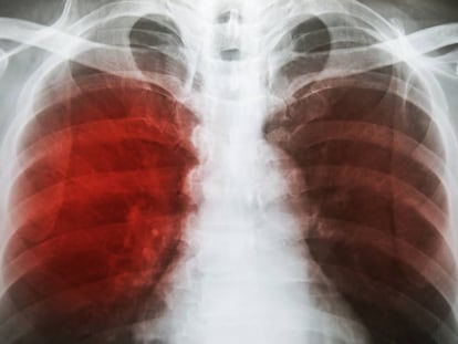 Radiografía de tórax muestra infiltración alveolar en ambos pulmones debido a infección por microbacterias tuberculosas.