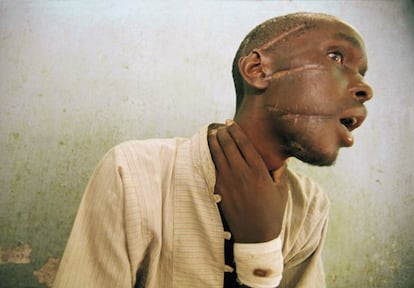 En apenas 48 horas, las ciudades fronterizas de Goma y Bukavu vieron llegar a 1,2 millones de refugiados ruandeses. Las infrahumanas condiciones de vida provocaron brotes de cólera, disentería, meningitis y otras enfermedades. En la imagen, el joven Nyabimana de 26 años muestra las heridas de machete en su cara a un comité de la Cruz Roja en Nyanza (Ruanda), el 4 de junio de 1994.