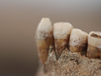 En esta dentadura de hace 5.000 años recuperada en el sur de Italia se puede apreciar perfectamente el sarro con restos de decenas de especies de bacterias.