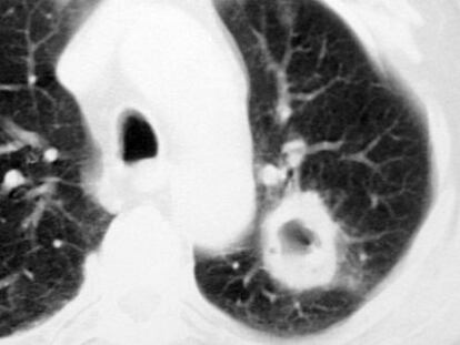 Tomograf&iacute;a computerizada de un c&aacute;ncer de pulm&oacute;n.