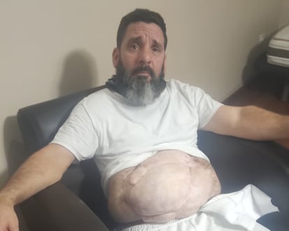 Leonardo Sánchez, cubano deportado a Liberia desde Estados Unidos en estado de salud grave por una hernia ventral. Agosto de 2026.