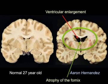 Aaron Hernandez sufría una Encefalopatía Traumática Crónica. Según los médicos, los daños que presentaba su cerebro, de 27 años, eran comparables a los de un hombre de 67 años.