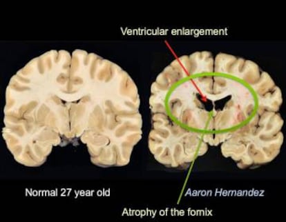 Aaron Hernandez sufría una Encefalopatía Traumática Crónica. Según los médicos, los daños que presentaba su cerebro, de 27 años, eran comparables a los de un hombre de 67 años.