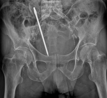 Radiografia de um homem de 68 anos com um destornillador no reto, em Cartagena.