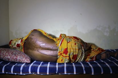 Asia Khatun trató de proteger a su marido de un hombre que quería hacerse con el pequeño terreno de la familia, y el ácido le cayó por la espalda. Asegura que en Bangladesh no se hace justicia, pero confía en que Alá castigue a la familia que contrató al sicario que llevó a cabo el ataque.